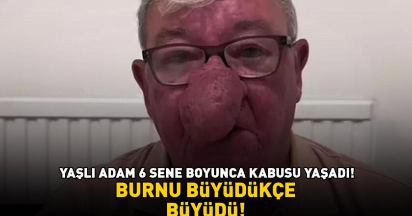 Burnu giderek büyüdü! 68 yaşındaki adam kabusunu yaşadı! 4 saat süren operasyonla adeta yeniden doğdu
